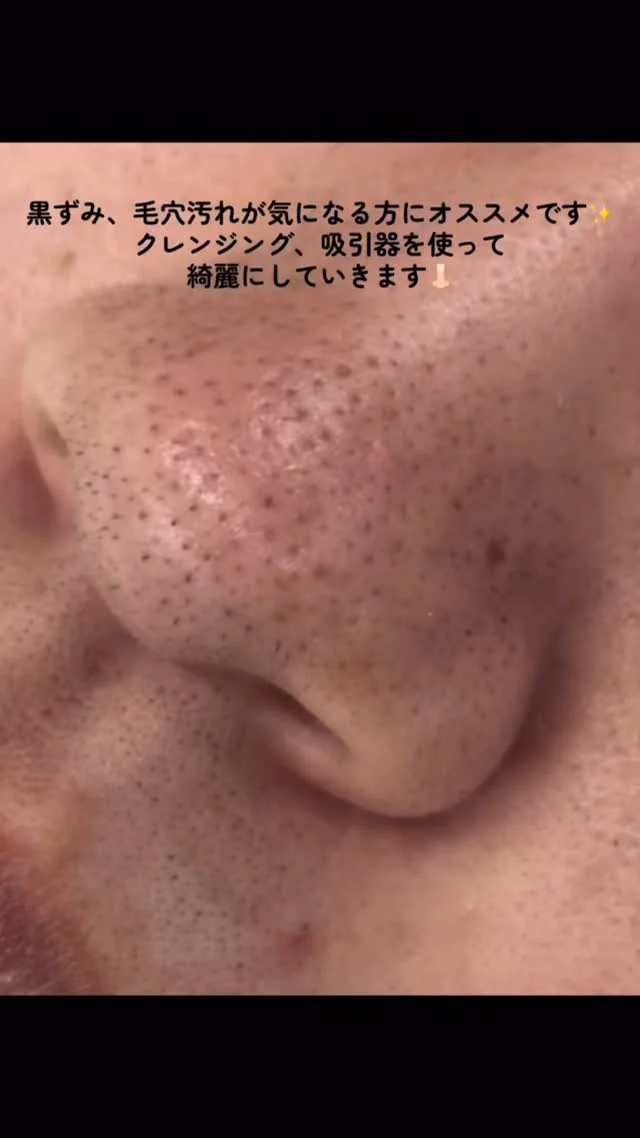 ・
当店人気オプション、小鼻クレンジング⭐️

パワーアップしてリニューアルしたので一回でこんなに綺麗に！
こちらも眉毛とセットで続けていただくとより効果的です👃🏻✨

眉ワックス＋小鼻クレンジング
3回目まで¥8800

📱12月LINEキャンペーン📱
初めて小鼻クレンジングをされる方はLINEを追加していただくだけで￥3850 → ￥2000でのご案内👀

📍店舖情報
東京都渋谷区代々木2-10-4
新宿CRビル6階
新宿駅南口から徒歩5分♪

ホットペッパービューティー、ホームページ、お電話からご予約頂けます！
皆様のご来店心よりお待ちしております🌟

#アイブロウスタイリング#メンズアイブロウ#メンズ眉毛
#メンズ眉毛サロン#メンズ専門#メンズスタイル#韓国眉毛#韓国へア#韓国眉#メンズ美容#メンズメイク#新宿#エサージュオム#エサージュオム新宿#まつ毛パーマ
#マツパ#メンズまつ毛パーマ#kpop#kpopアイドル風#メンズ#小鼻クレンジング#毛穴